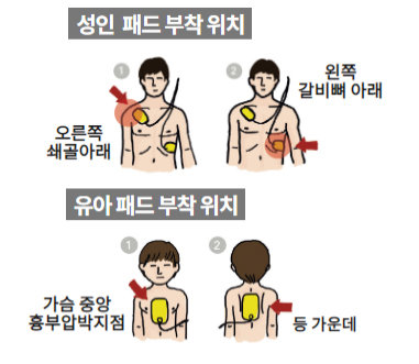 성인 패드 부착 위치 1. 오른쪽 쇄골아래 2. 왼쪽 갈비뼈 아래 유아 패드 부착 위치 1. 가슴 중앙 흉부압박지점 2. 등 가운데